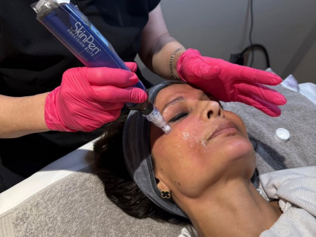 SkinPen at Vitalogy Wellness and Med Spa