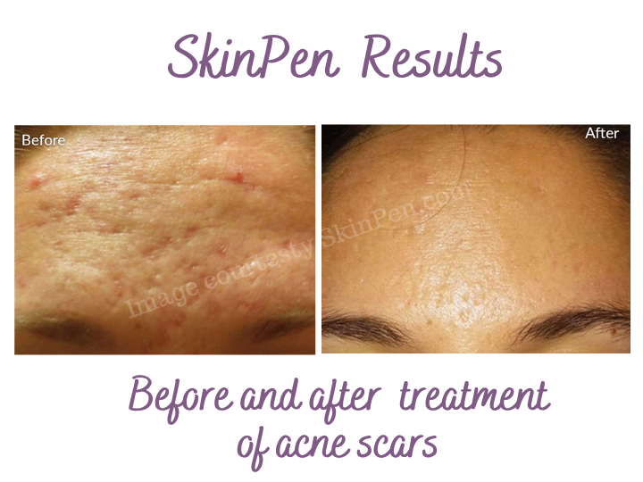 Before and after SkinPen Treatment for acne scars