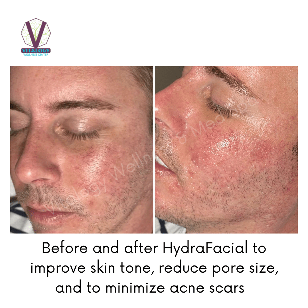 HydraFacial Before & After