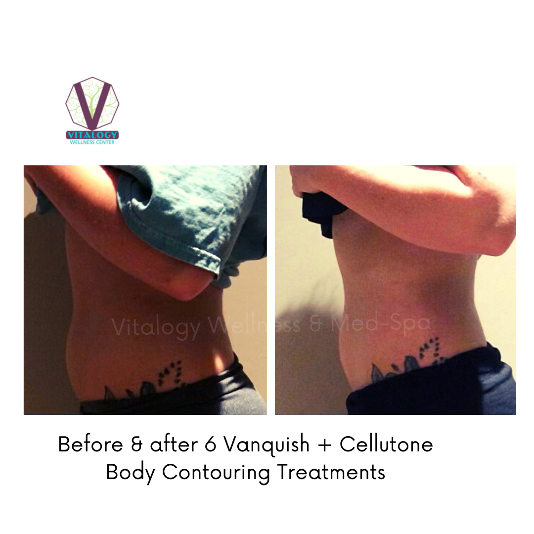 Cellutone + Vanquish ME Before & After