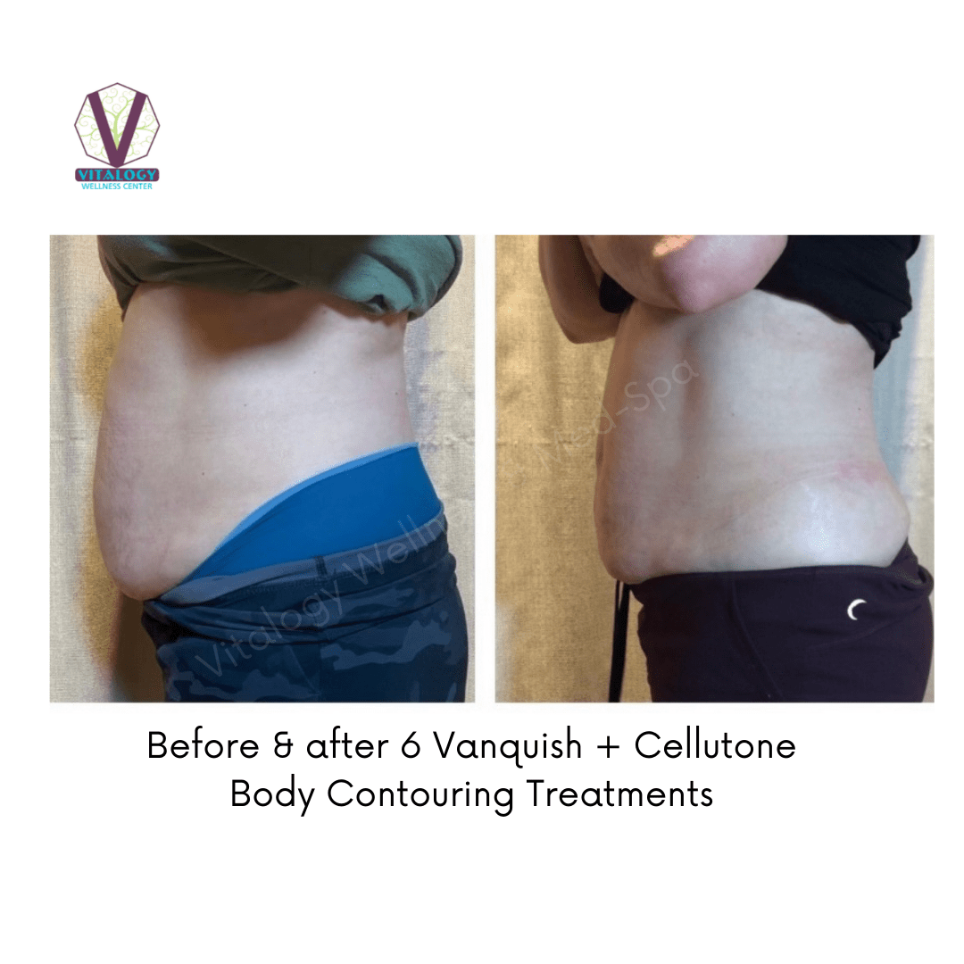 Before & After 6 Vanquish + Cellutone Body Contouring Treatments