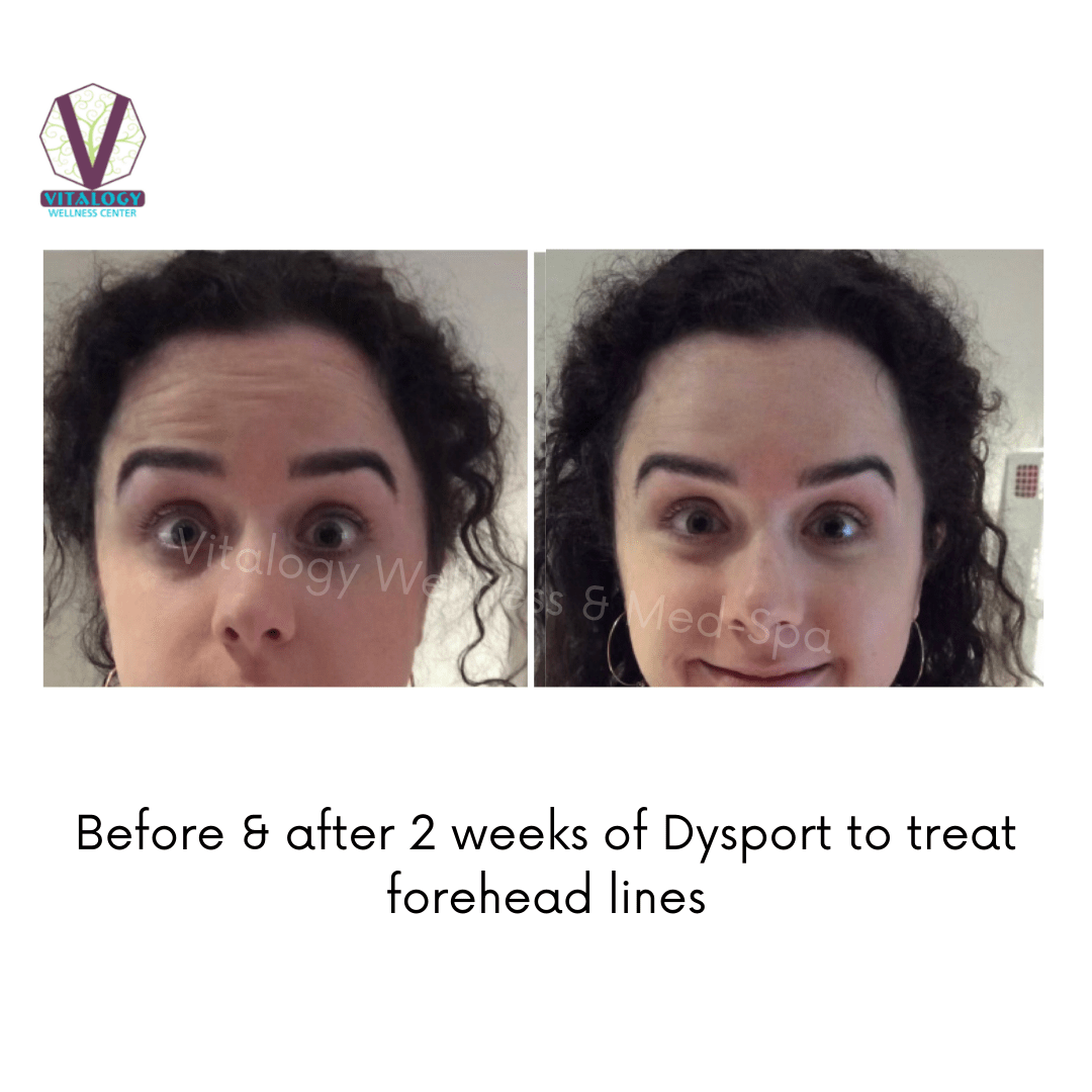 Dysport Before & After
