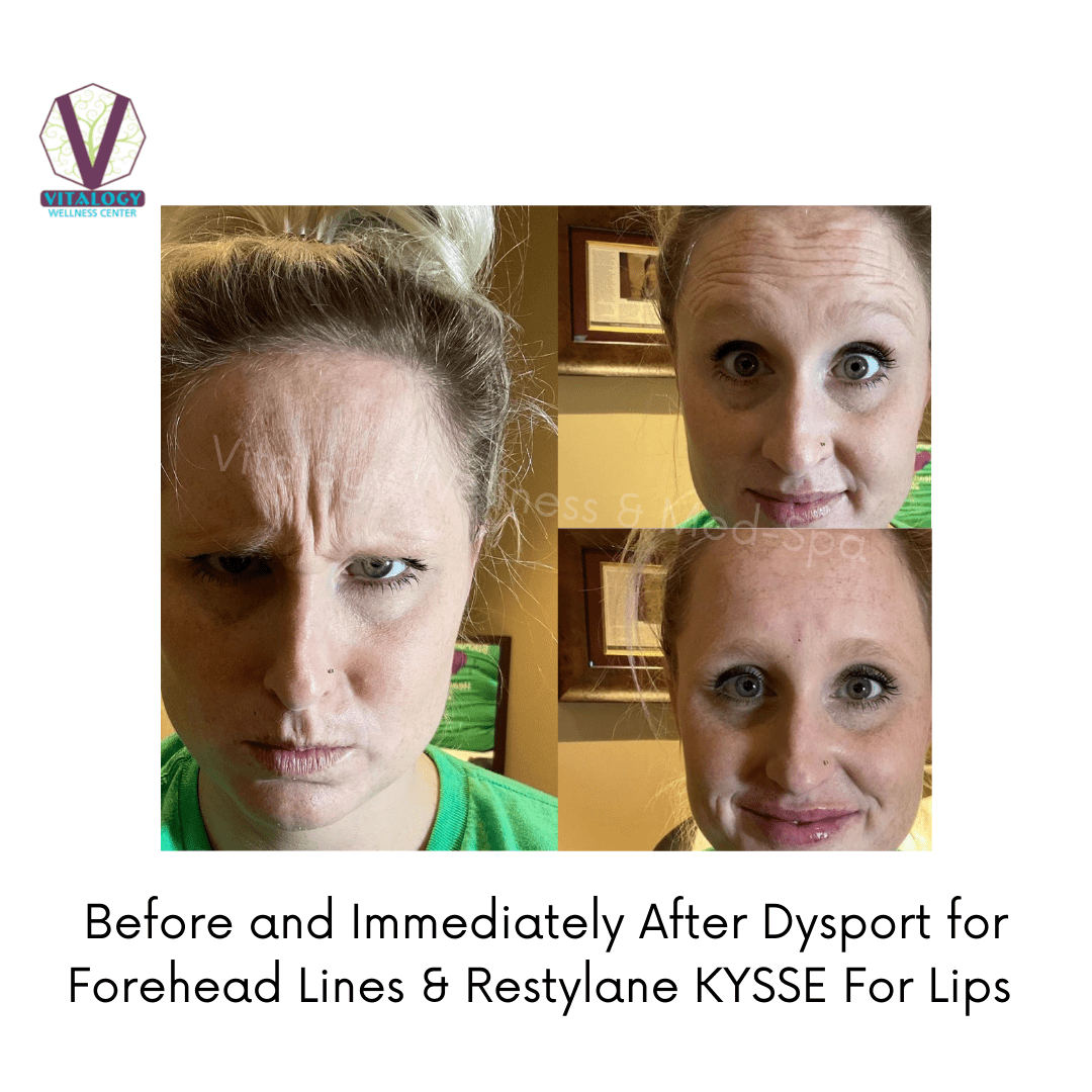 Before and immediately after Dysport and Restylane KYSSE For Lips By Dr. Farah Sultan at Vitalogy Wellness & Medical Spa in Homewood, Alabama