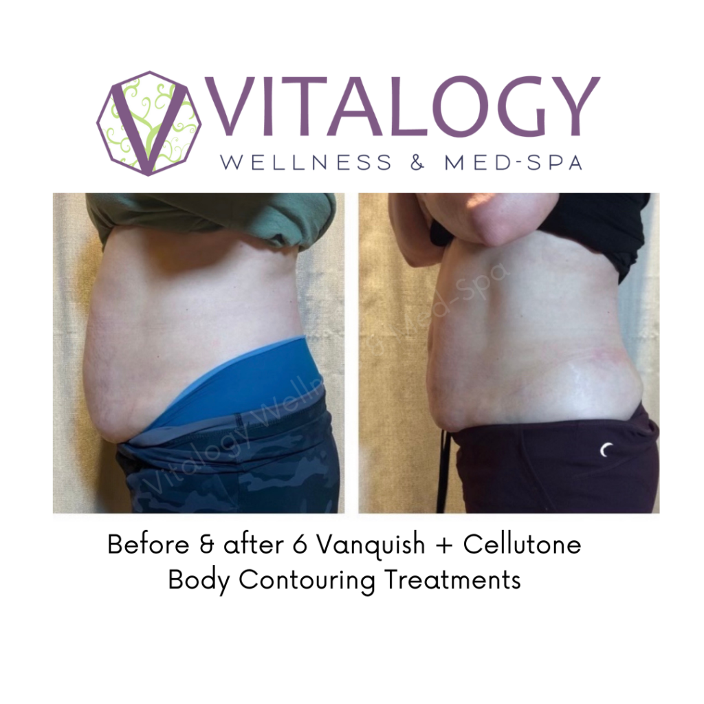 Gallery, Before & After Images, Vitalogy Med-Spa