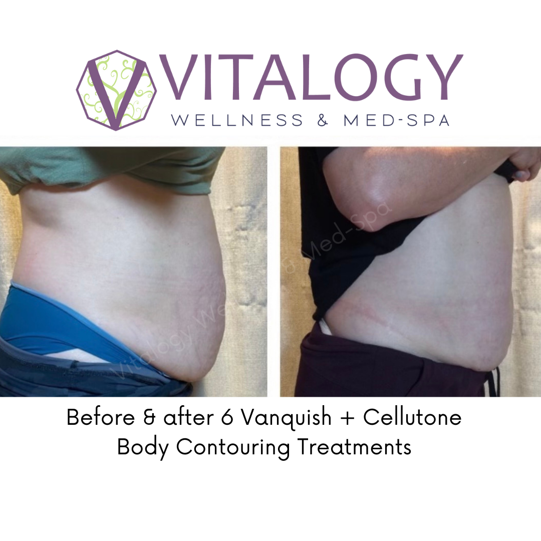 Before & After 6 Vanquish + Cellutone Body Contouring Treatments