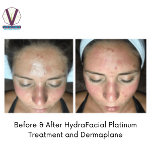 HydraFacial + Dermaplane Before & After