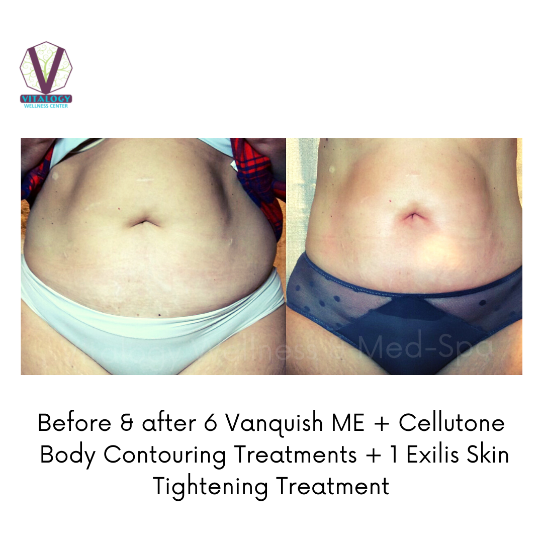Vanquish ME & Cellutone & Exilis Skin Tightening