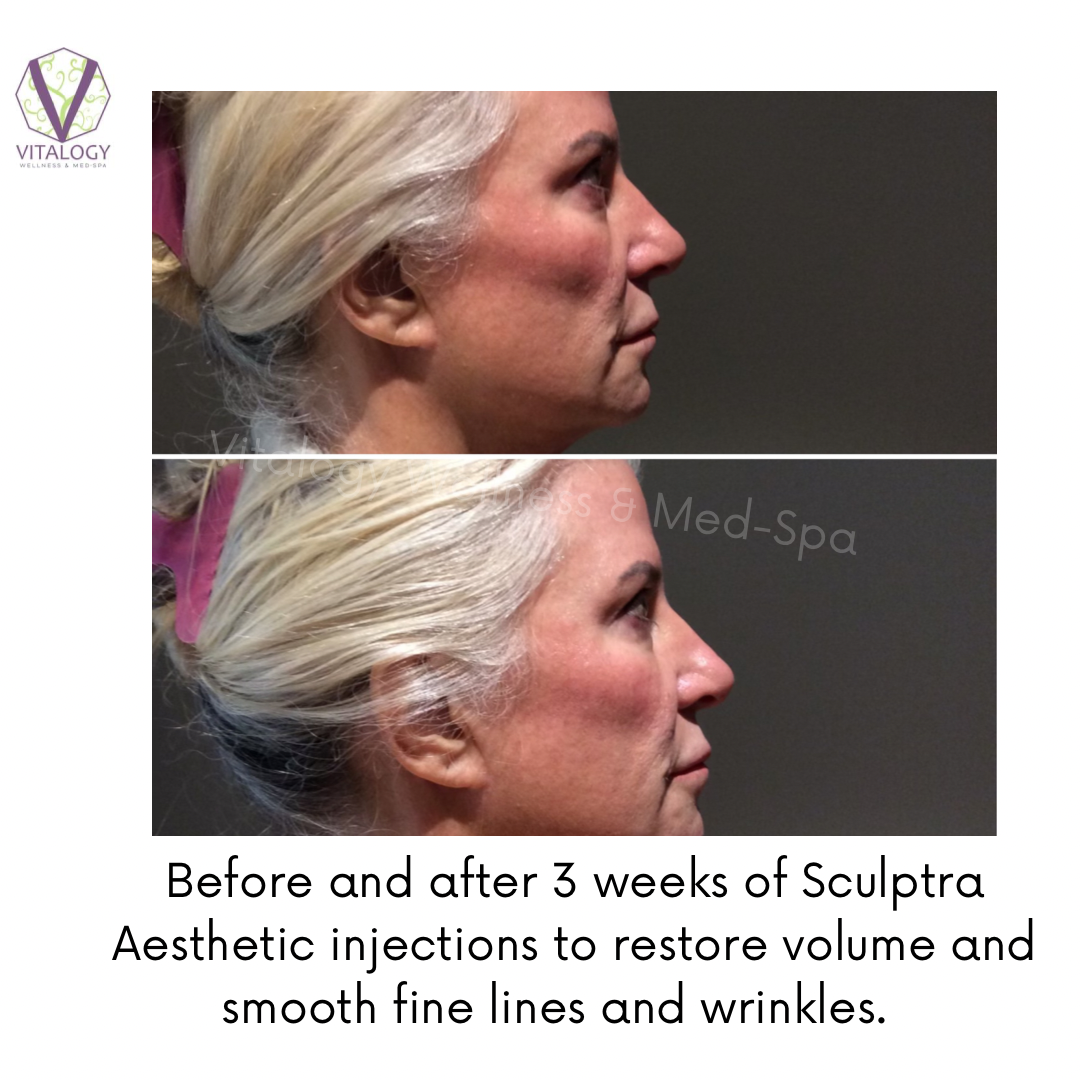 Sculptra before and after 3 weeks