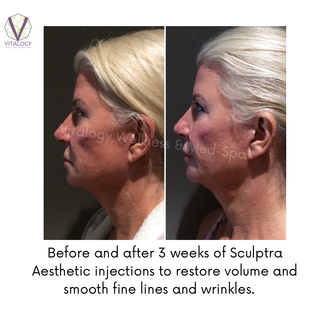 Before and after Sculptra injections for volume loss in the face