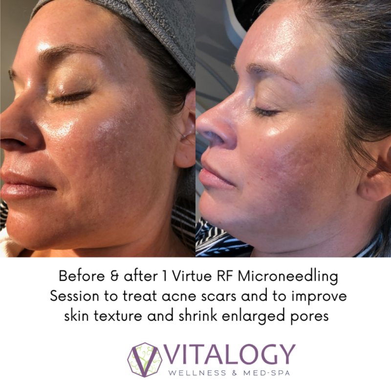 Before and after 1 Virtue RF Microneedling