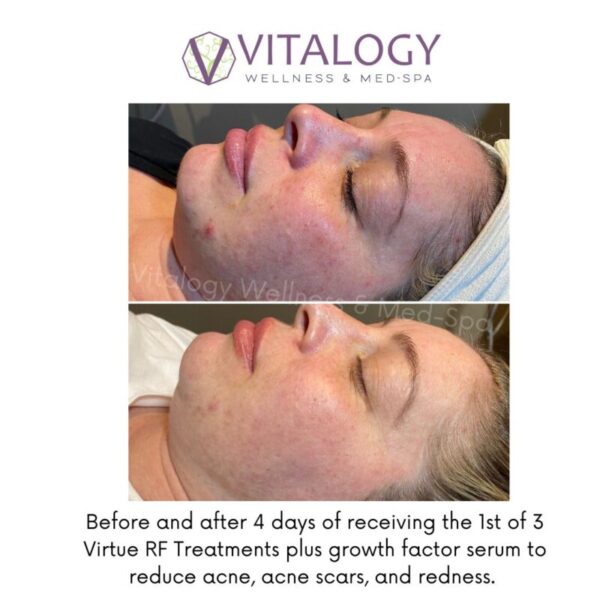 Before and After 4 days of receving the 1st of 3 Virtue RF Treatments plus growth factor serum to reduce acne,acne scars,and redness