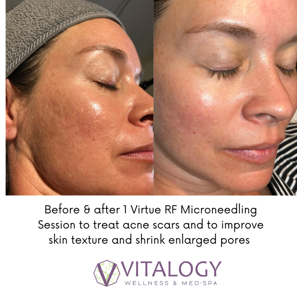 Virtue RF Microneedling Before & After