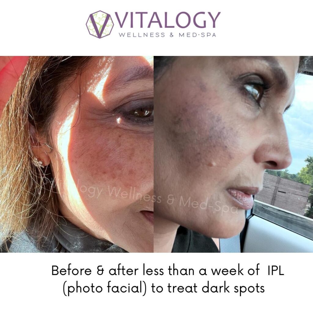 IPL Photo Facial Before & After