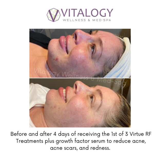 Before and After 4 days of receiving the 1st of 3 Virtue RF Treatments plus growth factor serum to reduce acne and acne scars and redness