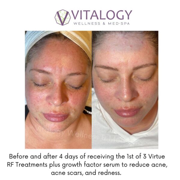 Before and After 4 days of receiving the 1st of 3 Virtue RF Treatments plus growth factor serum to reduce acne and acne scars and redness