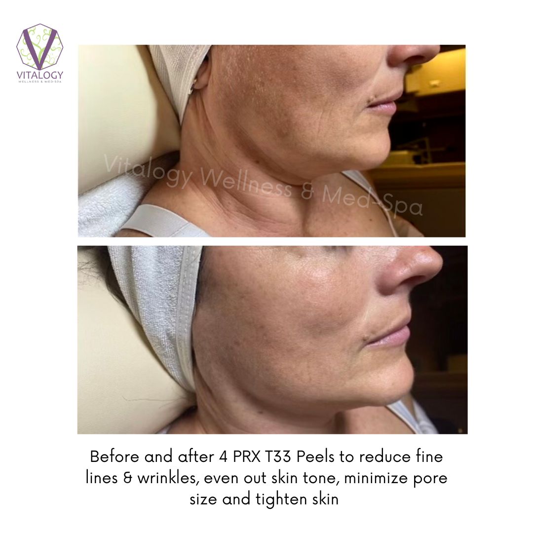 PRX T33 Before & After