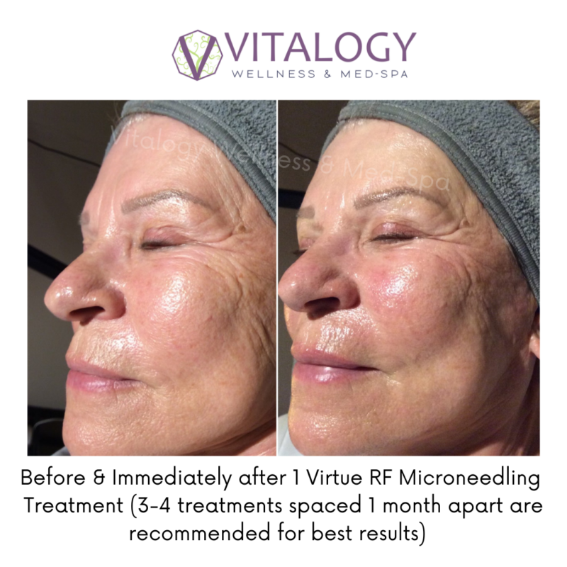 before and Immediately after 1 Virtue RF Microneedling Treatment (3-4 Treatments spaced 1 month apart are recommended for best results)