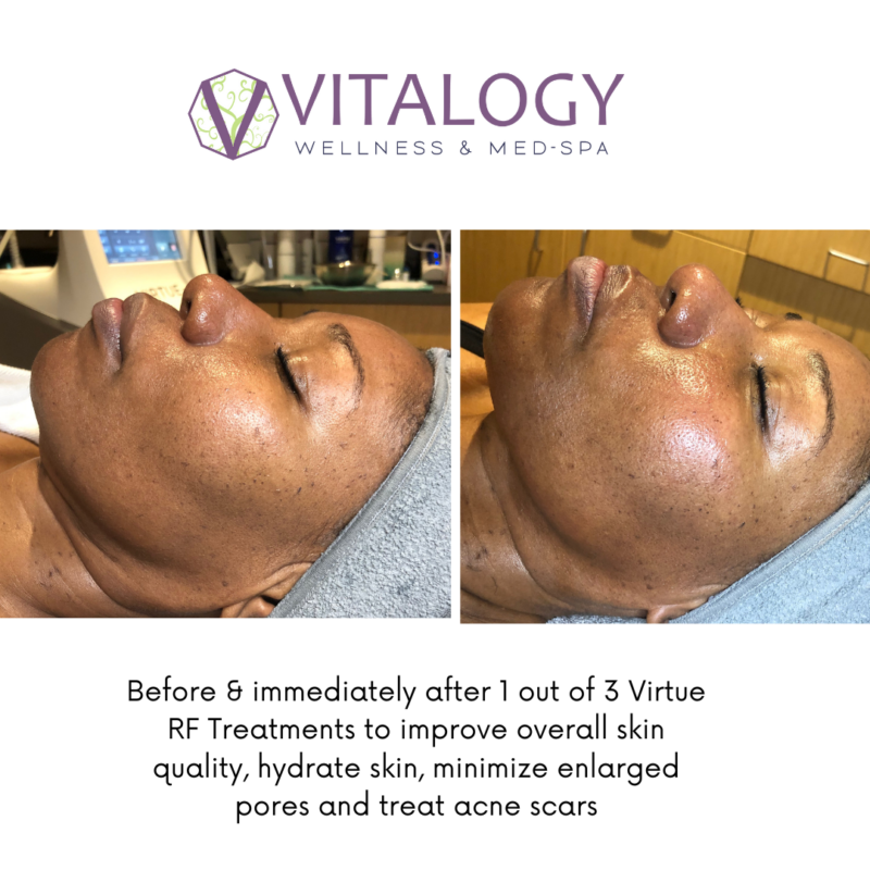 Before and after Virtue RF Microneedling