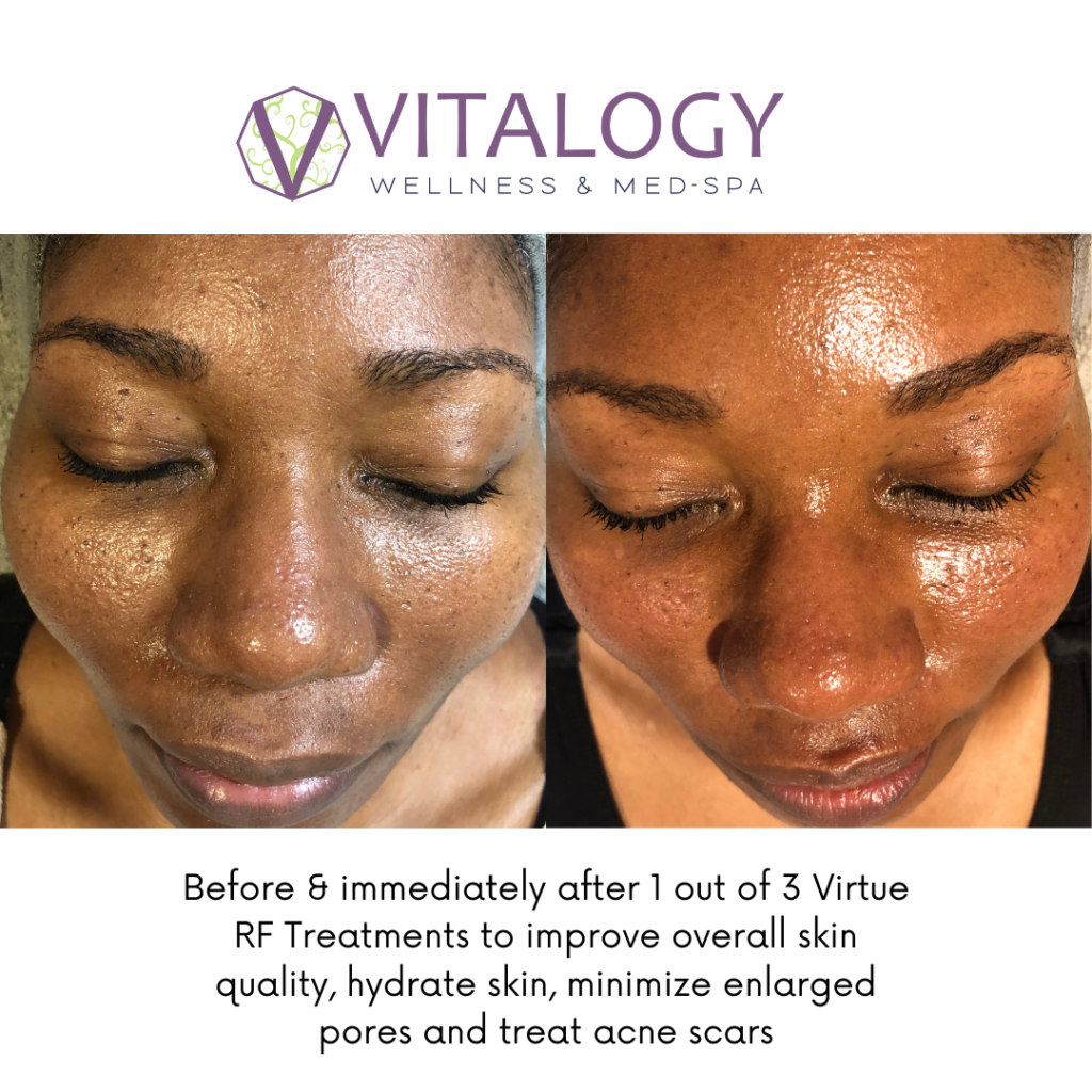 Gallery, Before & After Images, Vitalogy Med-Spa