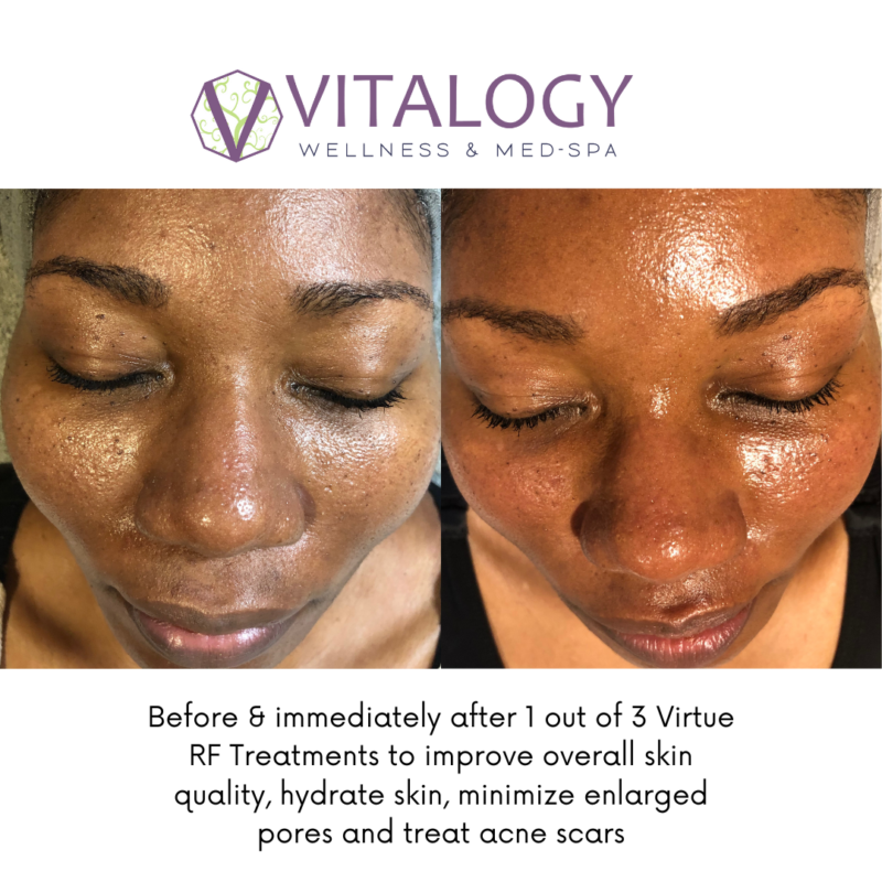Gallery - Virtue RF Results Before and after one session