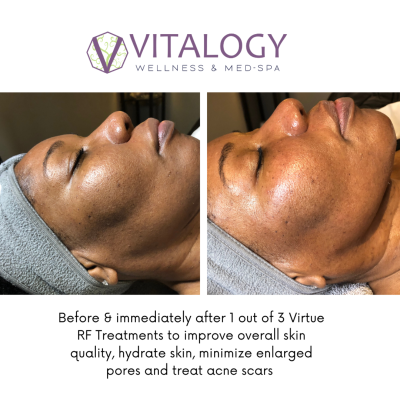 Gallery - Virtue RF Results Before and after one session