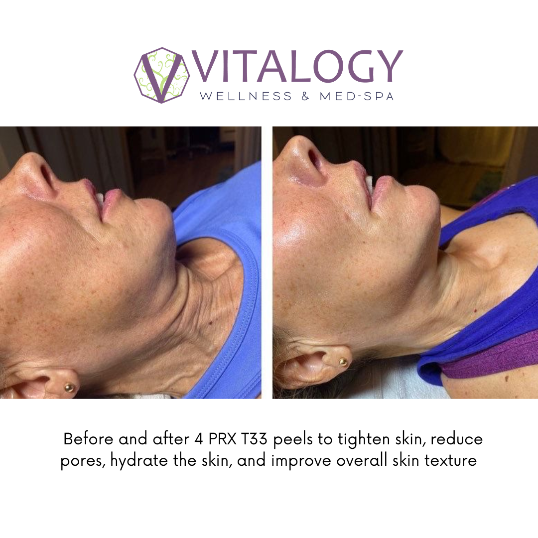 Skin Rejuvenation Results using PRX Derm Perfexion