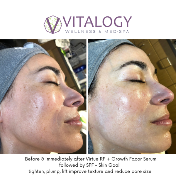 Before and after Virtue RF with Growth factor serum