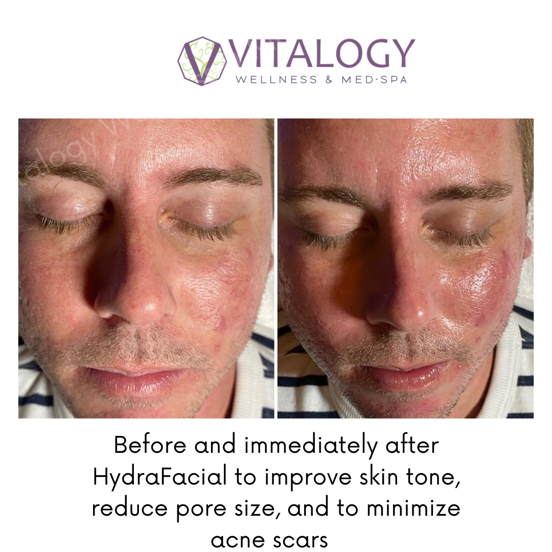 Before and immediately after Hydrafacial to improve skin tone, reduce pore size, and to minimize acne scars