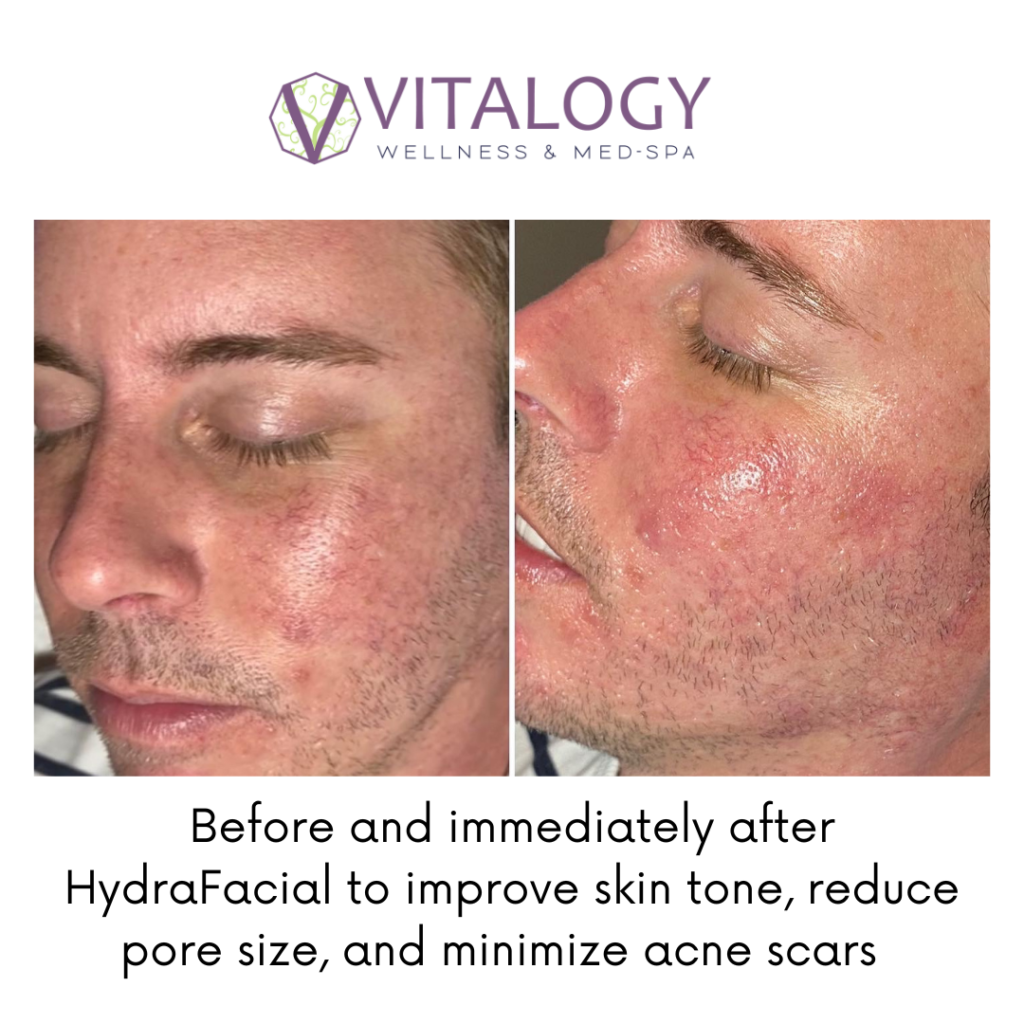 Gallery, Before & After Images, Vitalogy Med-Spa