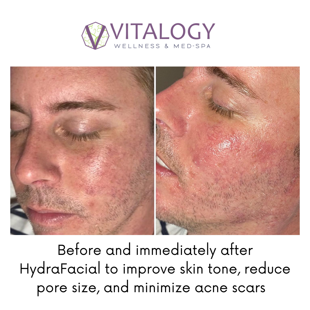 Before and immediately after Hydrafacial to improve skin tone, reduce pore size, and minimise acne scars