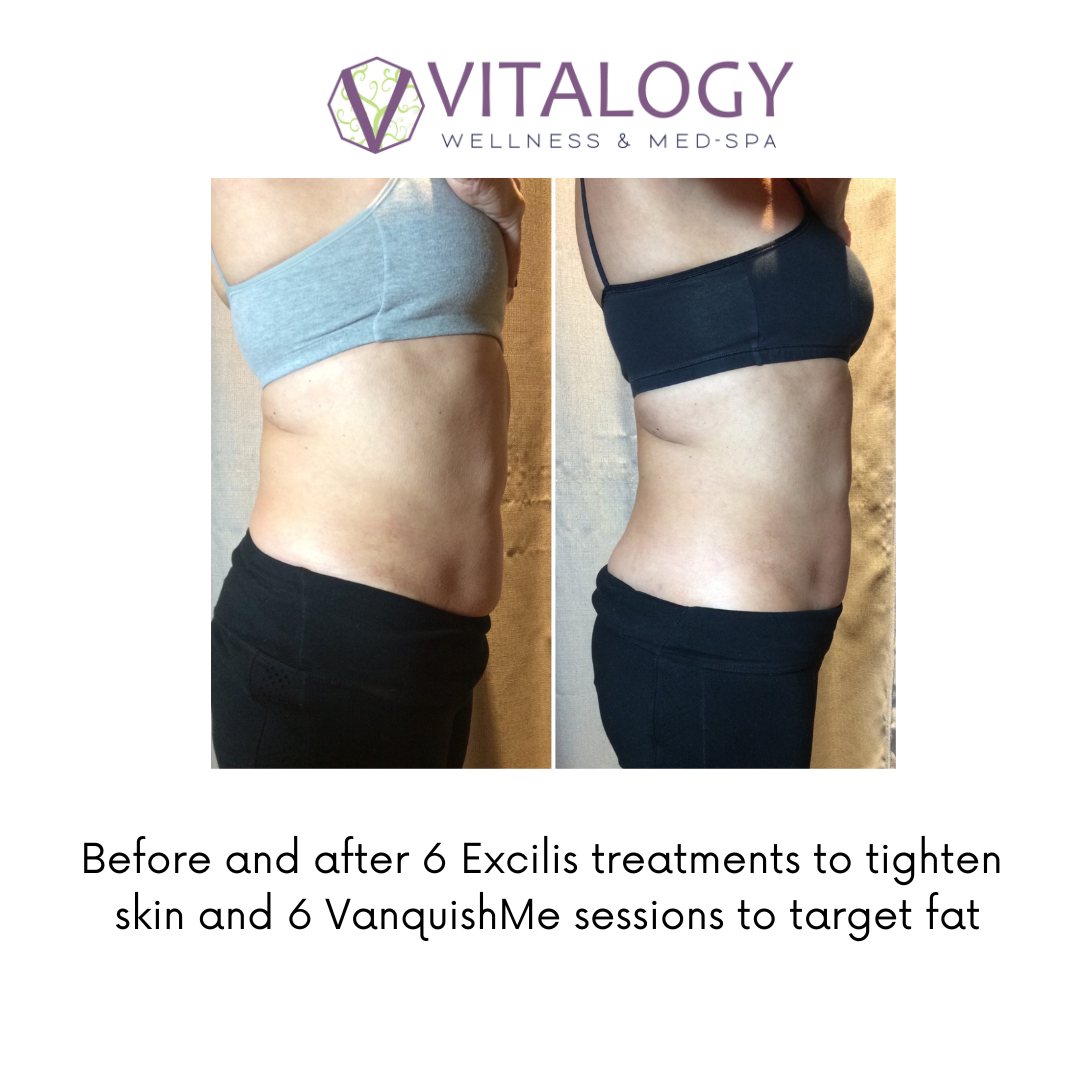 Before and after Excilis & Vanquish Body Contouring-  By Dr. Farah Sultan at Vitalogy Wellness & Medical Spa in Homewood, Alabama