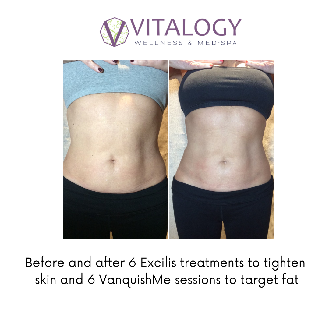 Before and after Excilis & Vanquish Body Contouring-  By Dr. Farah Sultan at Vitalogy Wellness & Medical Spa in Homewood, Alabama