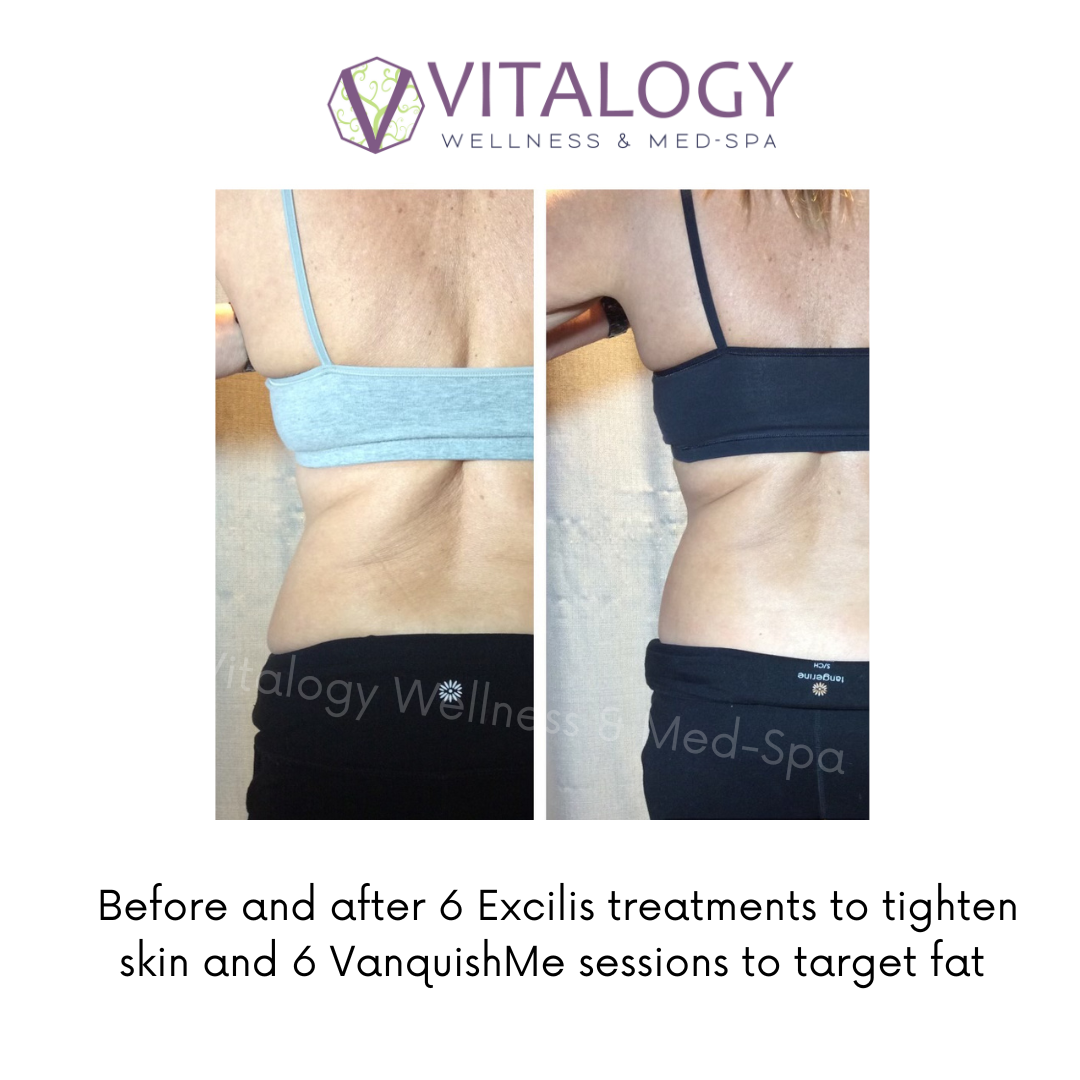 Before and after Excilis & Vanquish Body Contouring-  By Dr. Farah Sultan at Vitalogy Wellness & Medical Spa in Homewood, Alabama