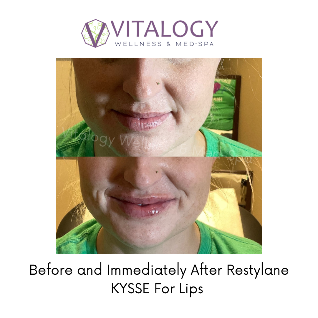 Before and After Restylane Kysse for Lip by Dr Farah T.Sultan