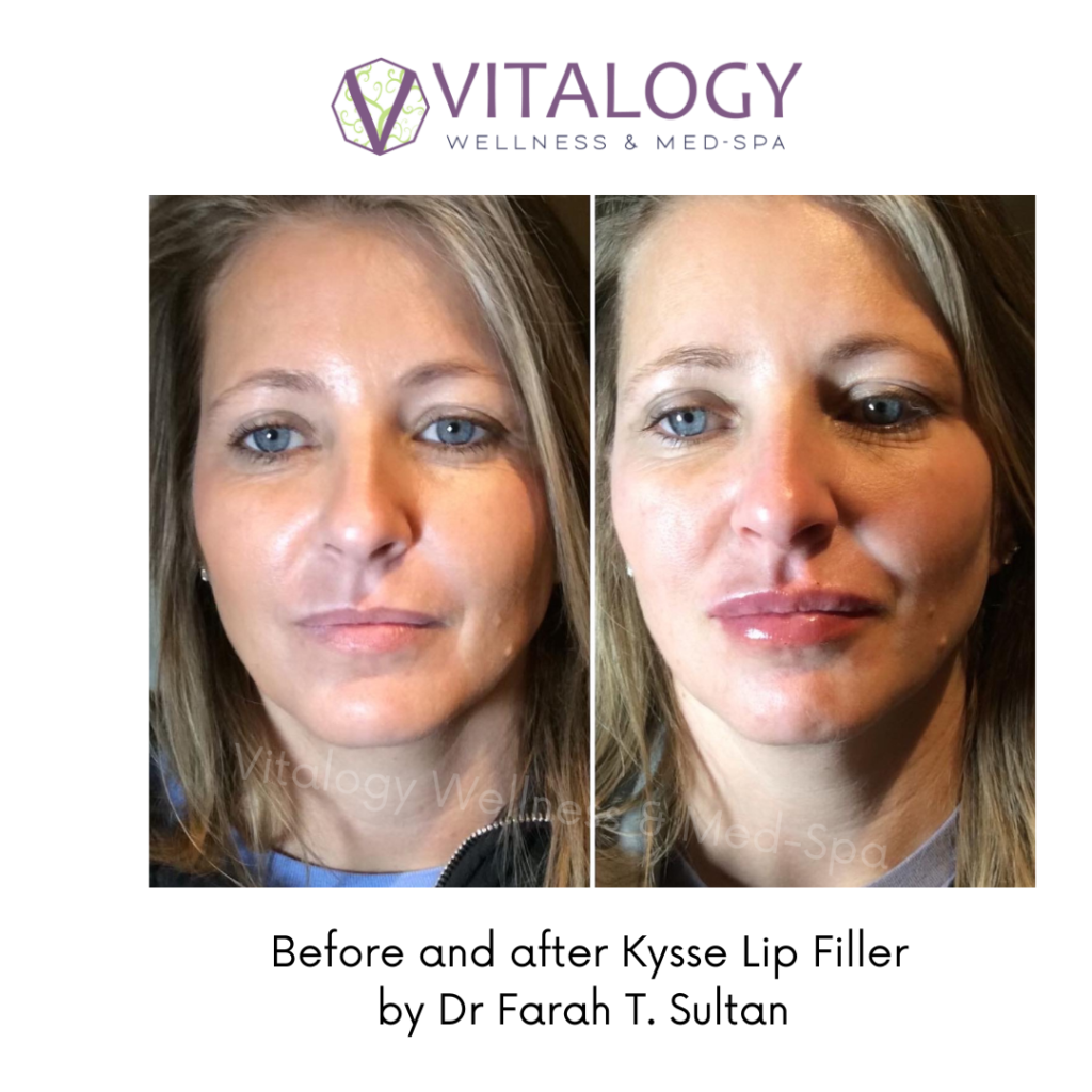 Injectables Gallery  Vitalogy Wellness & Med-Spa