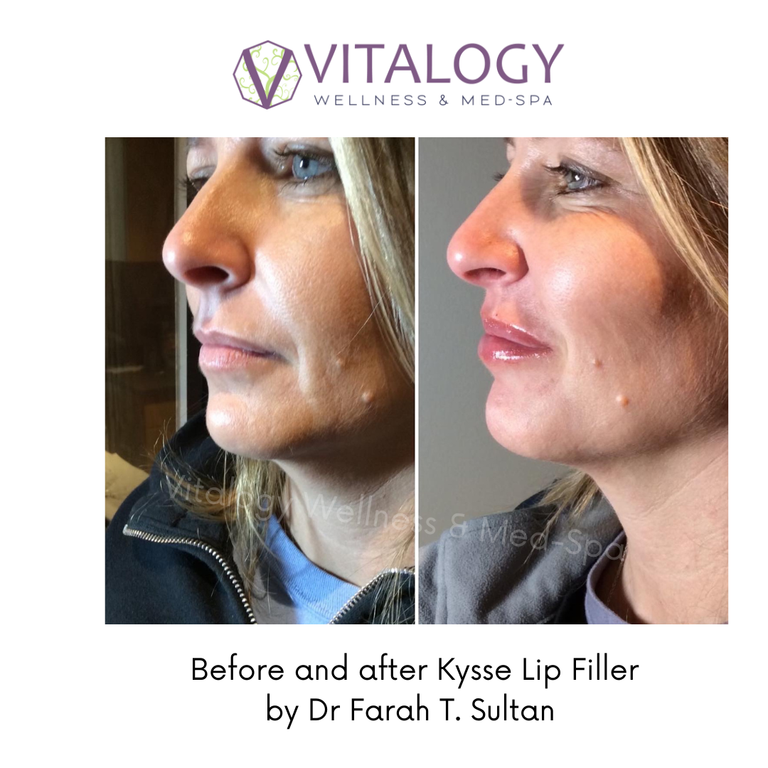 Before and After Kysse Lip Filler by Dr Farah T.Sultan