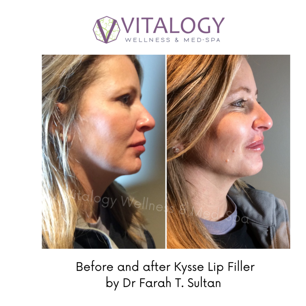 Injectables Gallery  Vitalogy Wellness & Med-Spa