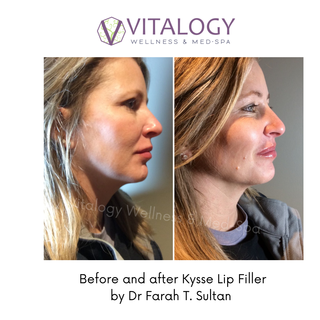 Before and After Kysse Lip Filler by Dr Farah T.Sultan
