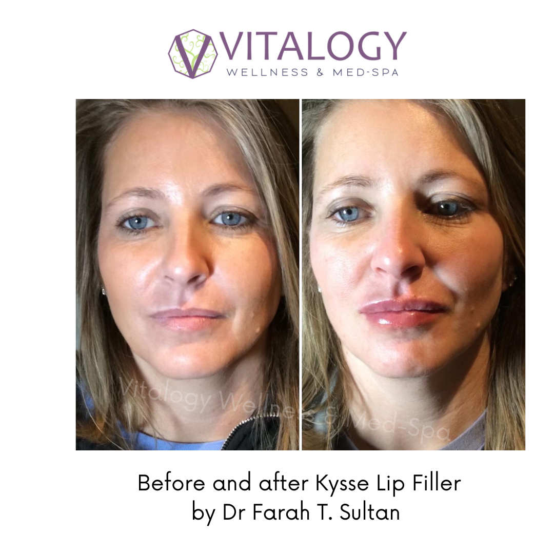 Before and After Kysse Lip Filler by Dr Farah T.Sultan