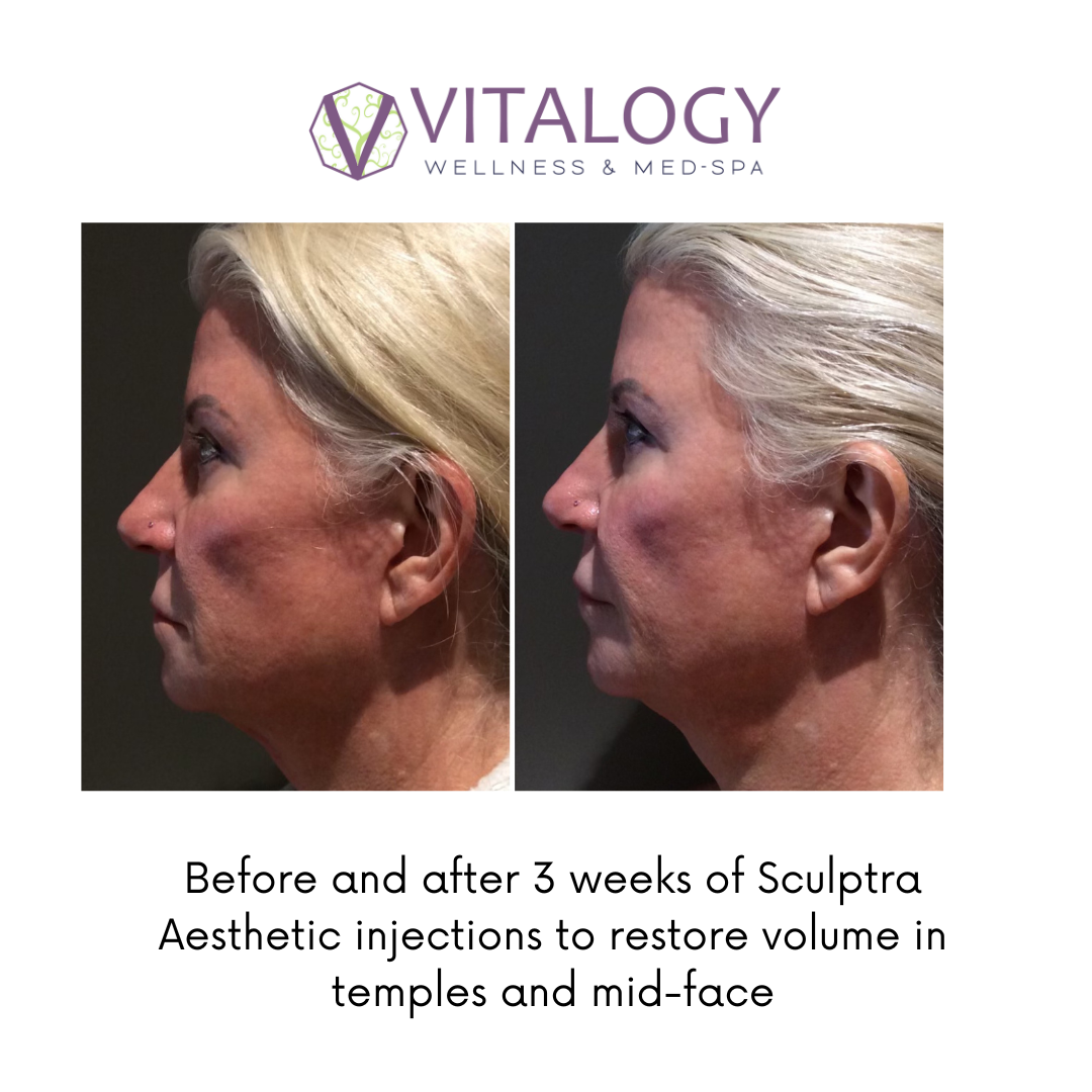 Before and After 3 Weeks of Sculptra Aesthetics injections to restore volume in temples and mid face
