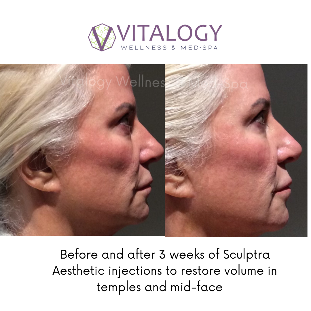 Before and After 3 Weeks of Sculptra Aesthetic Injections to restore volume in temples and mid-face