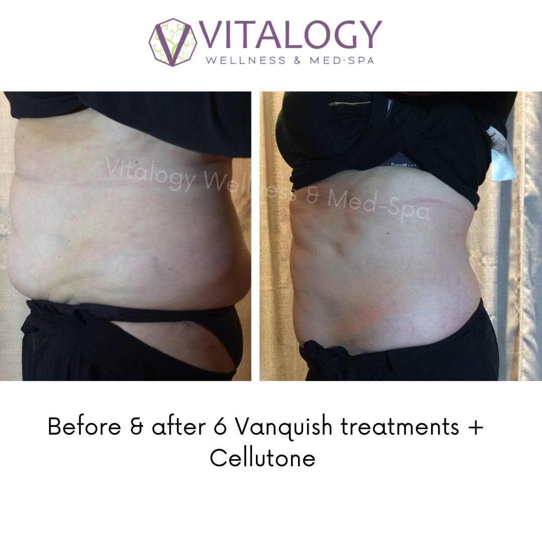 Before and after VanquishMe and Cellutone - Body Contouring
