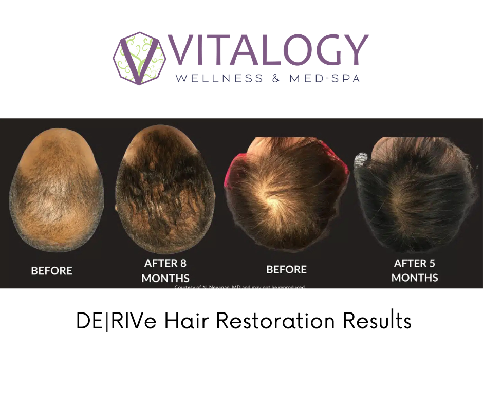 Before and after DE|RIVE Hair Restoration - copyright AMP provider network