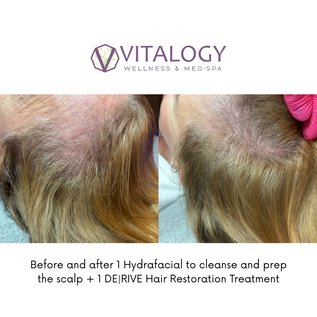 Before and after DE|RIVE Hair restoration treatment + Hydrafacial for cleaning the scalp