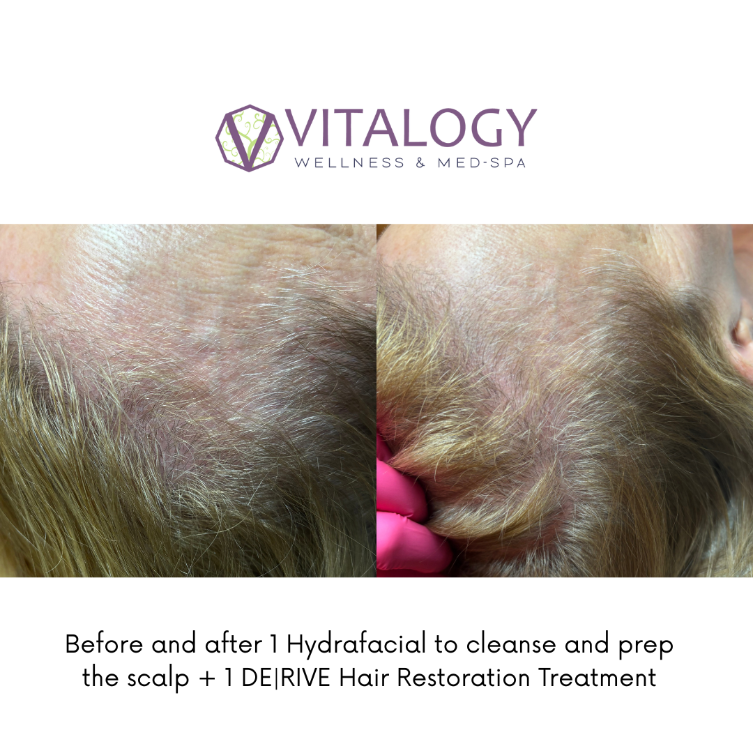 Before and after DE|RIVE Hair restoration treatment + Hydrafacial for cleaning the scalp