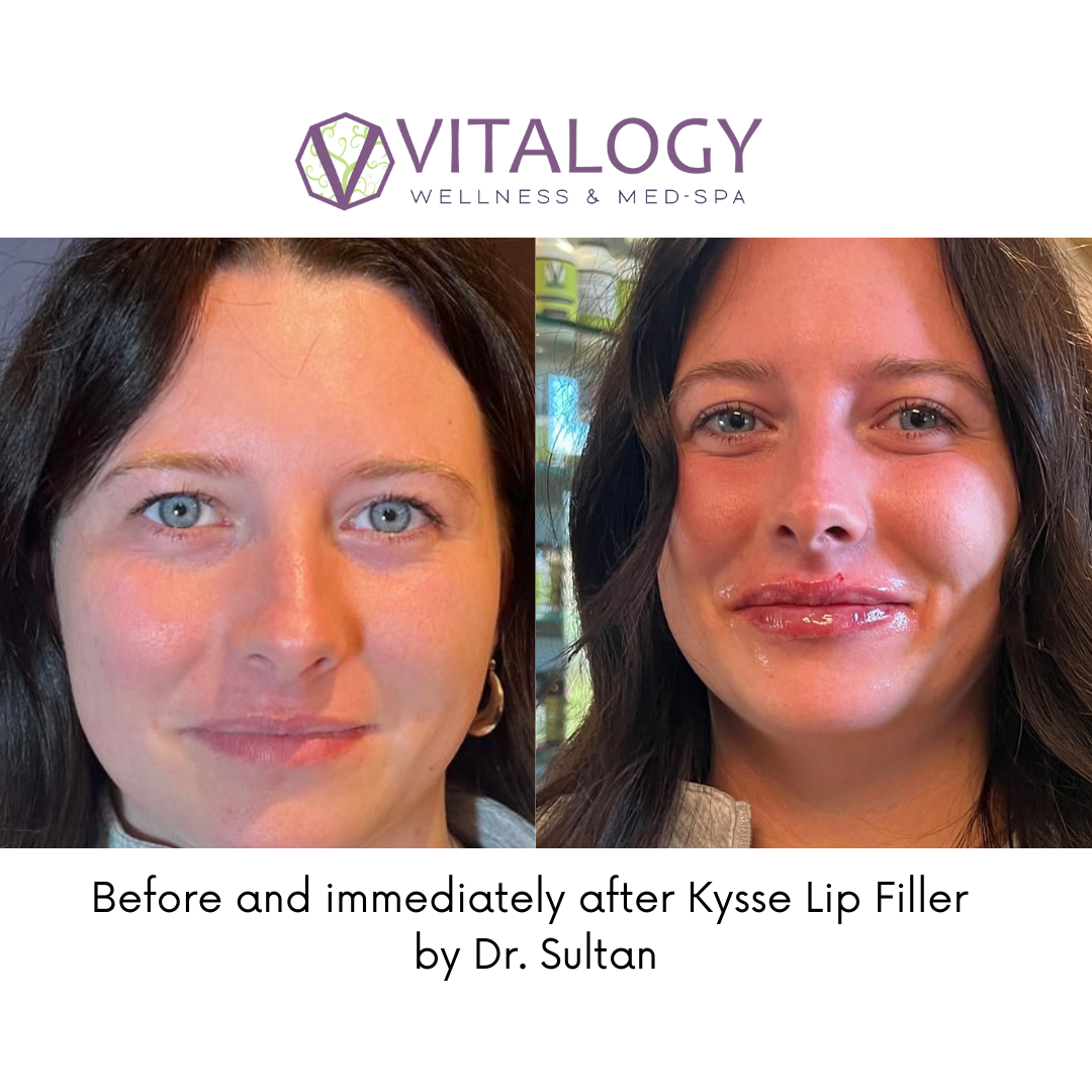 Before and immediately after Kysse Lip Filler by Dr. Sultan